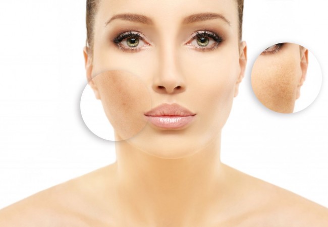 Hyperpigmentation – how to remove it once and for all?